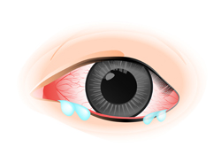 希瑪眼科中心_結膜炎症狀_流眼水畏光