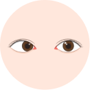 兒童斜弱視
