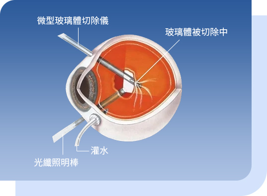 希玛眼科中心_视网膜脱落治疗_微创玻璃体切除术 希玛眼科中心_视网膜脱落治疗_微创玻璃体切除术