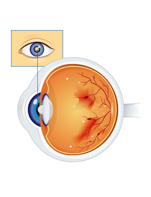 希玛眼科中心_糖尿性视网膜病变
